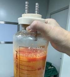 浚县水动力吸脂手术要做多久？